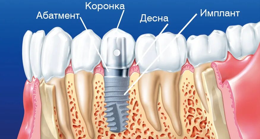 Как делают зубы на штифтах