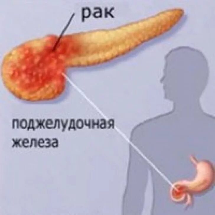 Симптомы рака поджелудочной у мужчин признаки. Злокачественные новообразования поджелудочной железы. Как выглядит опухоль поджелудочной железы. Экзокринные опухоли поджелудочной железы. Ракьподжелудочной железы.