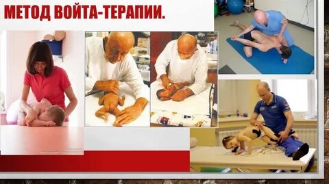 Войта терапия дцп