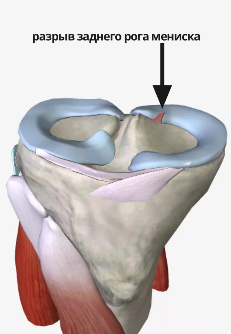 Задний Рог медиального мениска 2 Столлер. Дистрофические изменения заднего рога мениска