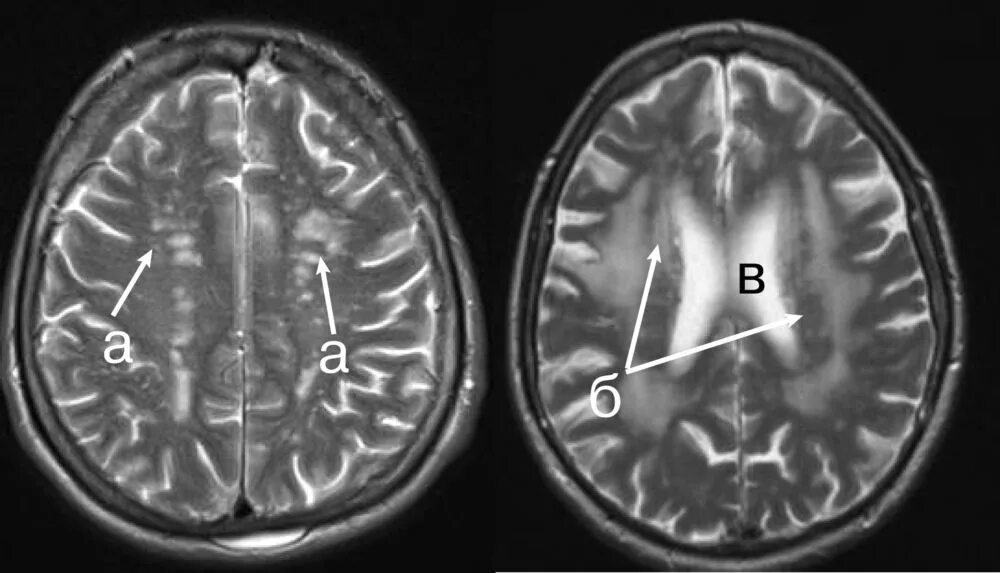 Микроангиопатия головного мозга fazekas. Лейкоареоз головного мозга мрт. Перивентрикулярный лейкоареоз на кт. Перивентрикулярный лейкоареоз головного мозга мрт. Рассеянный склероз лейкоареоз.