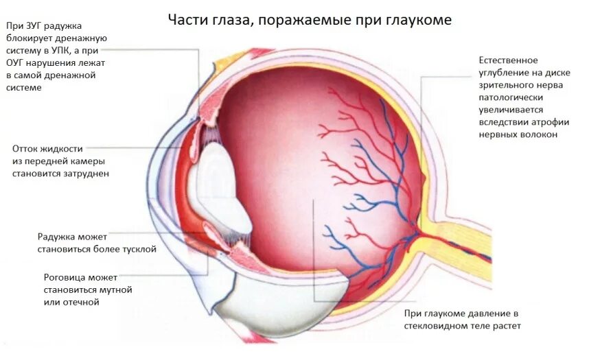 Глаукома глаза причины. Глаукома строение глаза. Повышение внутриглазного давления симптомы.