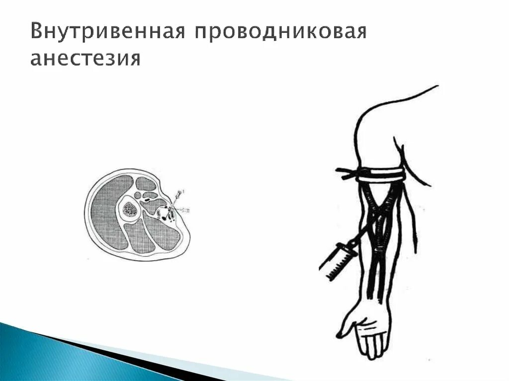 Проводниковая анестезия по Брауну-Усольцевой. Проводниковая анестезия по Оберсту-Лукашевичу. Местная анестезия схема. Внутривенная регионарная анестезия. Что такое проводниковая анестезия