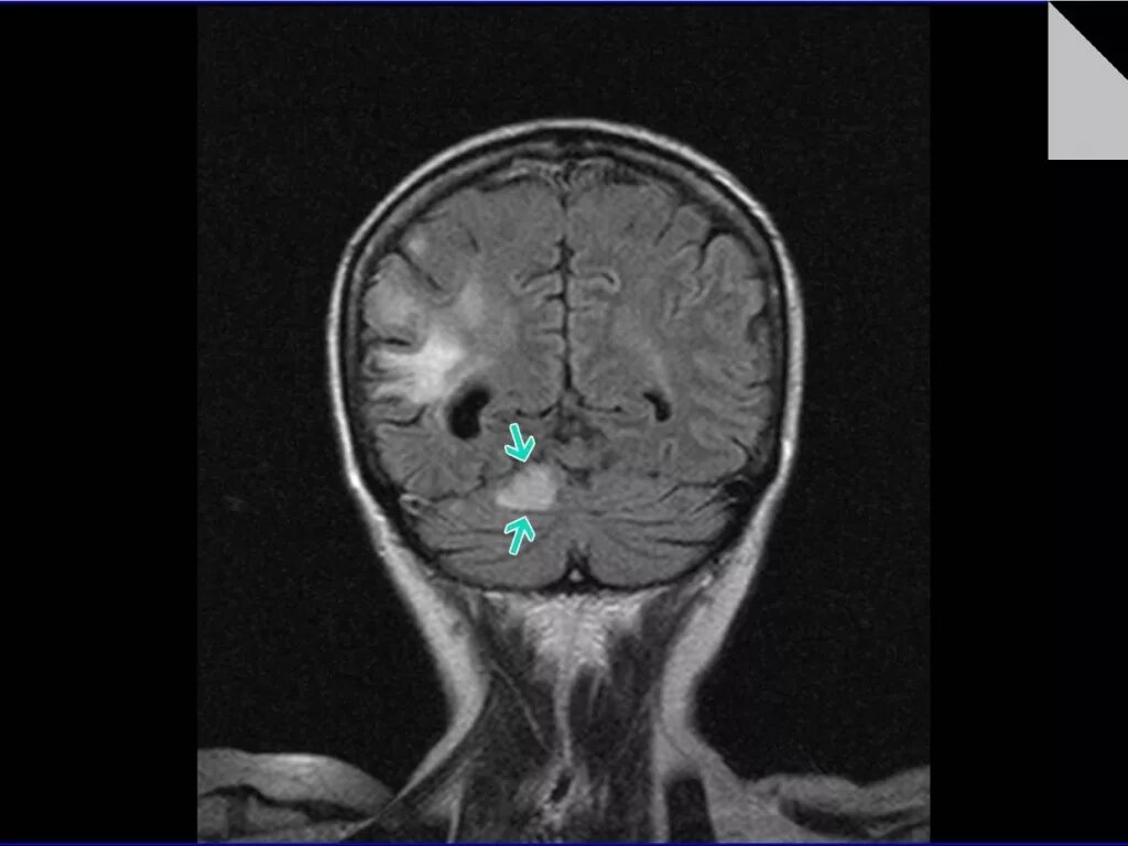 мрт головного мозга шизофрения. полуоткрытый мрт томограф 1. посттравматическая энцефалопатия головного мозга на мрт. наружная гидроцефалия головного мозга мрт. мрт головного мозга аппарат мрт.