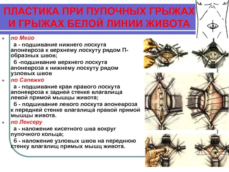 Операция грыжа белой