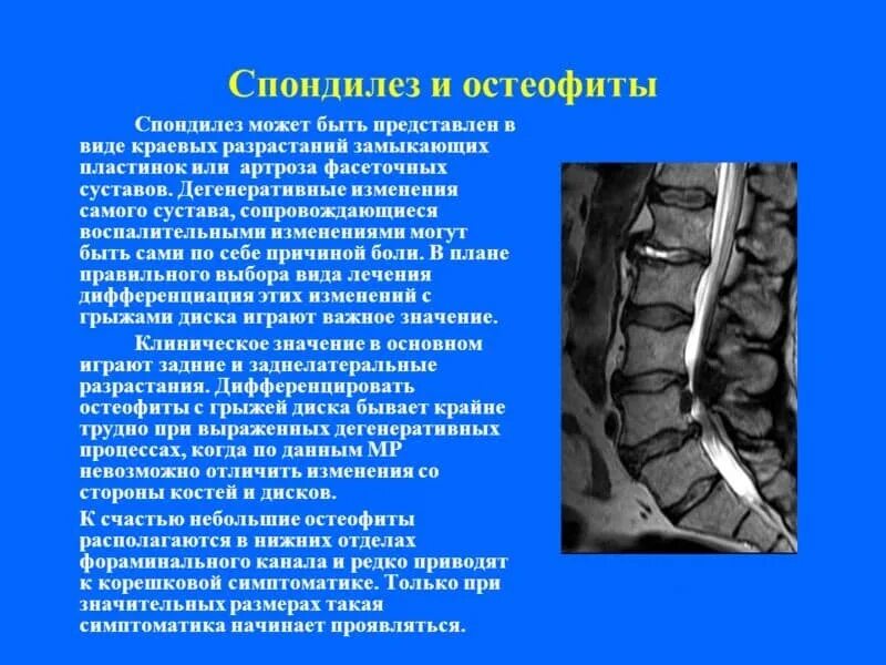 Спондилеза спондилоартроза поясничного отдела позвоночника. Спондилез л3 л5. Спондилез l1-l5 что такое. Деформирующий спондилез l2 l5. Деформирующий спондилез с3-с4.