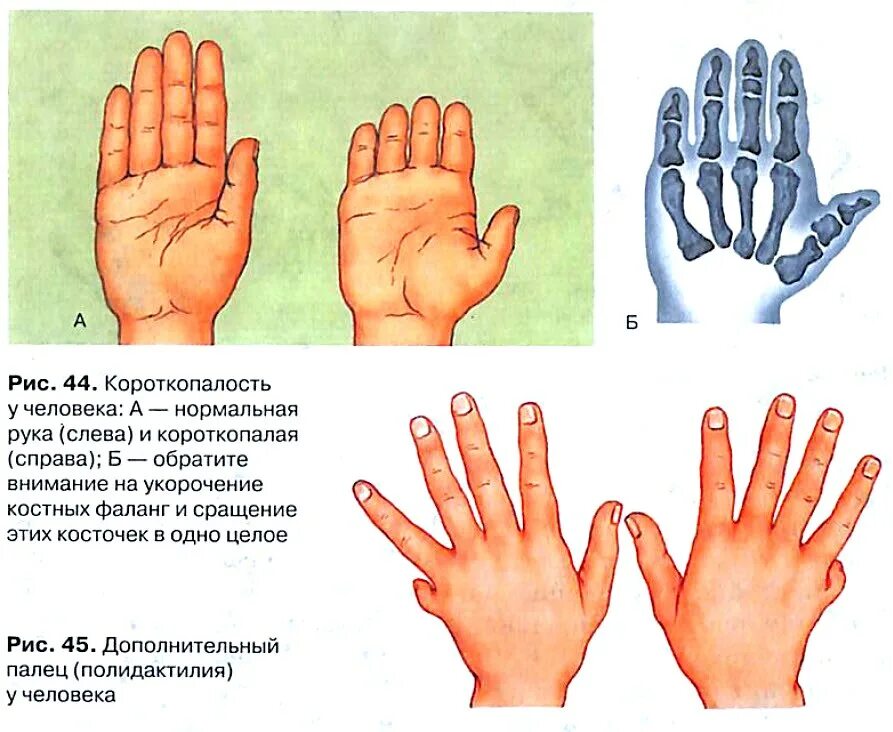 Появление рецессивных мутаций. Мутационная изменчивость примеры. Примеры наследственной изменчивости у человека. Мутационная изменчивость примеры у человека. Примеры наследственной мутационной изменчивости.