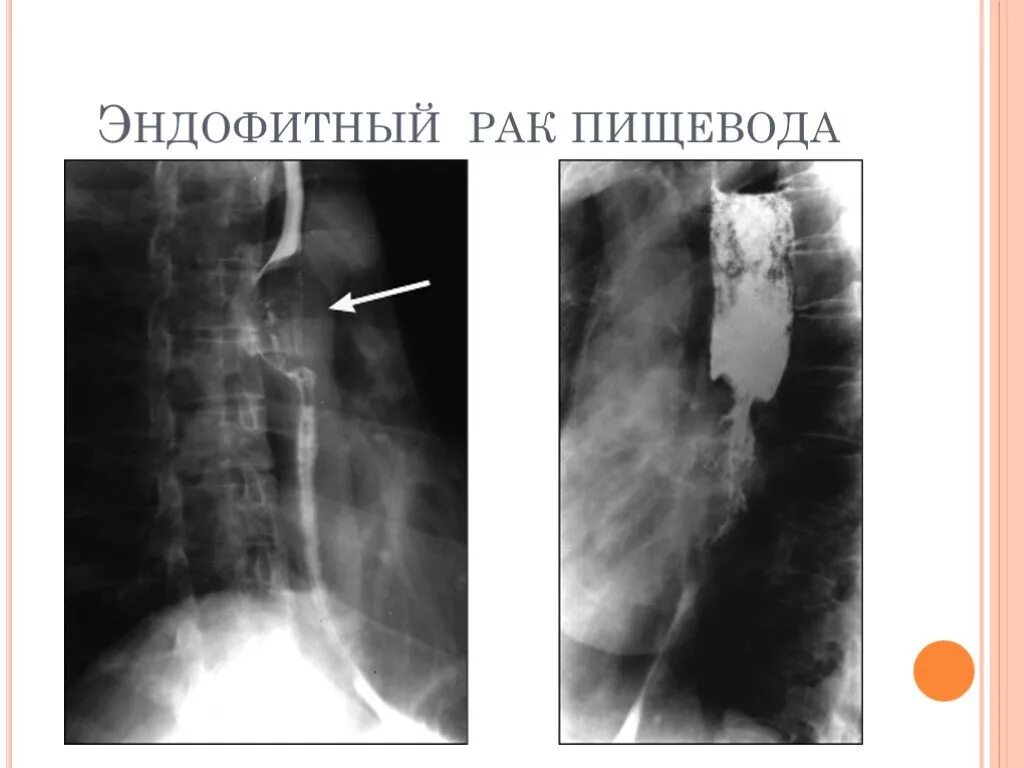 Пищевода выживаемость