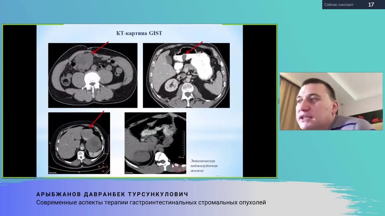 Гастроинтестинальные опухоли клинические рекомендации. Доброкачественные опухоли блок схема патология. Гастроинтестинальные опухоли клинические рекомендации. Гастроинтестинальные опухоли клинические рекомендации. Интрамуральные опухоли желудка.