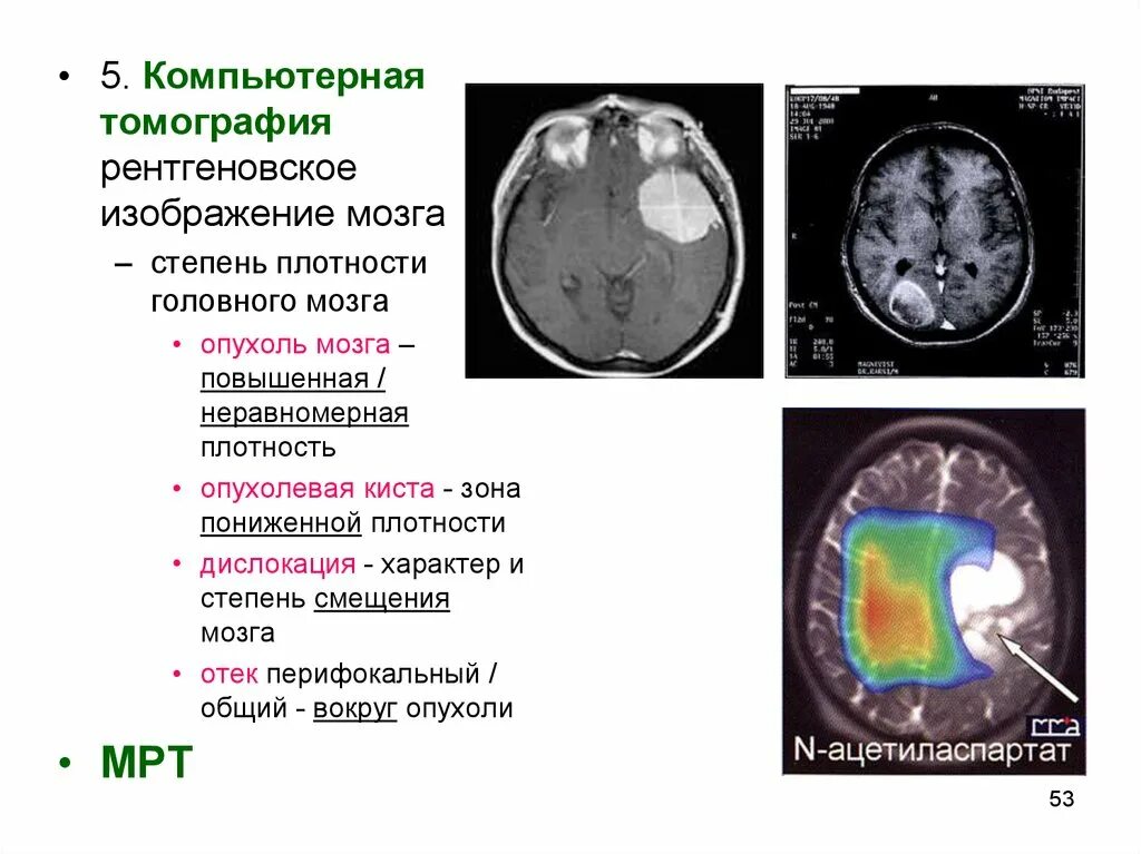 Плотность злокачественной опухоли на кт. Глиома головного мозга кт. Перифокальный отек головного мозга на кт. Очаг пониженной плотности в головном мозге на кт.