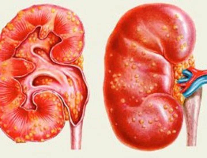 1. острый пиелонефрит симптомы. почечное заболевание пиелонефрит. односторонний и двусторонний пиелонефрит. 3 пиелонефрит.