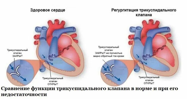 Регургитация трехстворчатого клапана. Регургитация трикуспидального клапана степени. Регургитация трехстворчатого клапана степени. Трикуспидальный клапан сердца 1 степени.