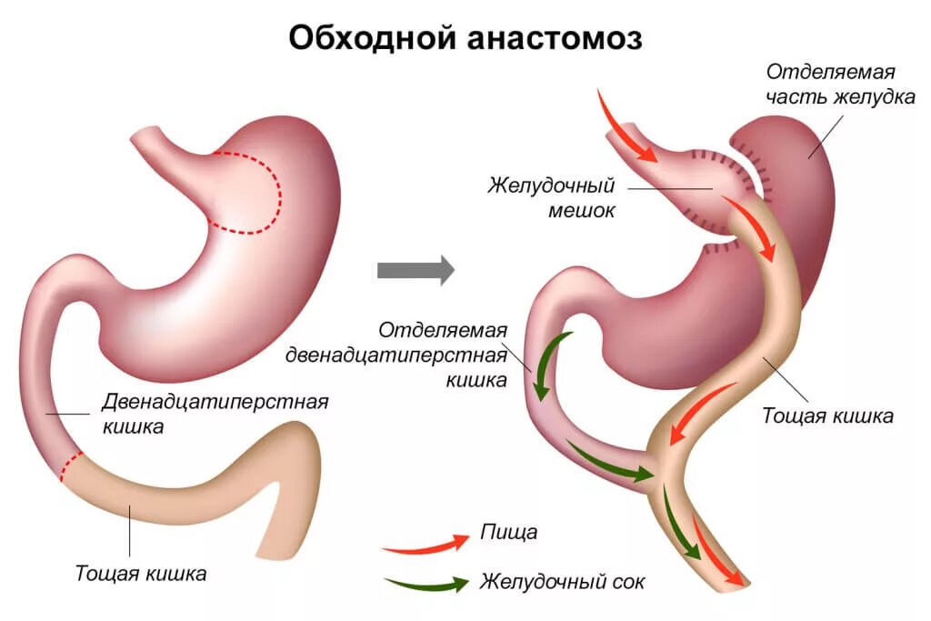 Резекция желудка анастомозы. Панкреатодигестивный анастомоз. Анастомозит что это