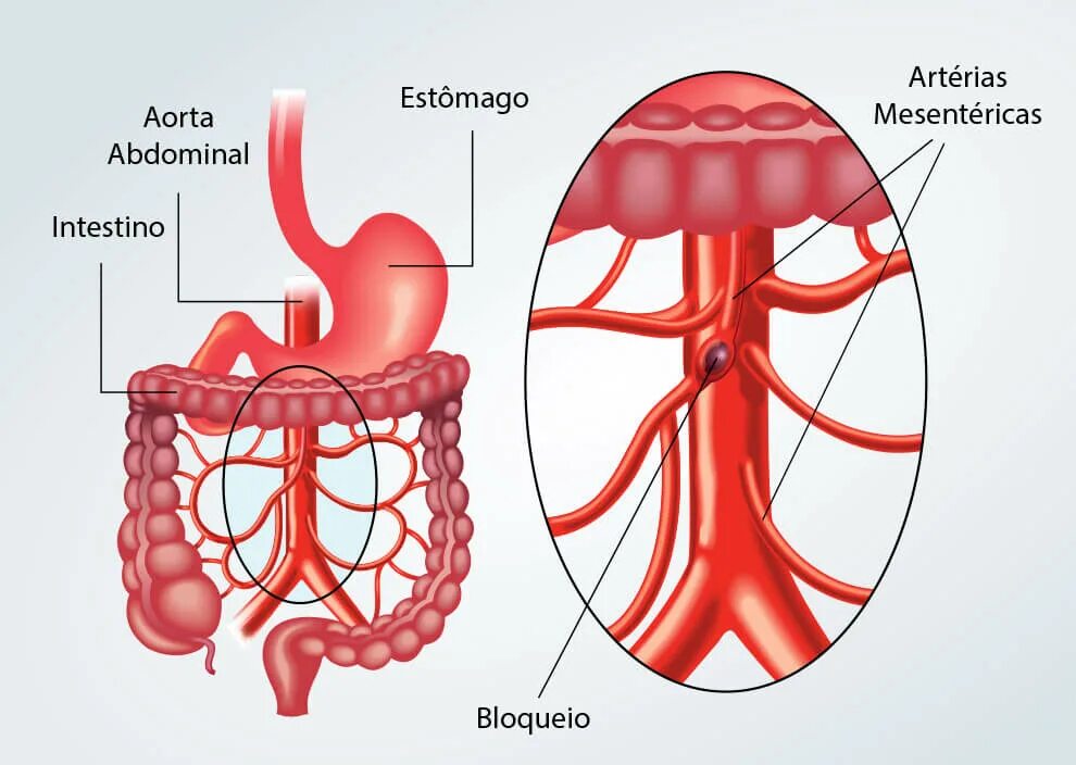 Брюшная ишемия. Мезентериальный тромбоз сосудов кишечника. Тромбоз мезентеральных сосудов. Тромбоз мезентериальные сосуды. Мезентериальные сосуды кишечника.