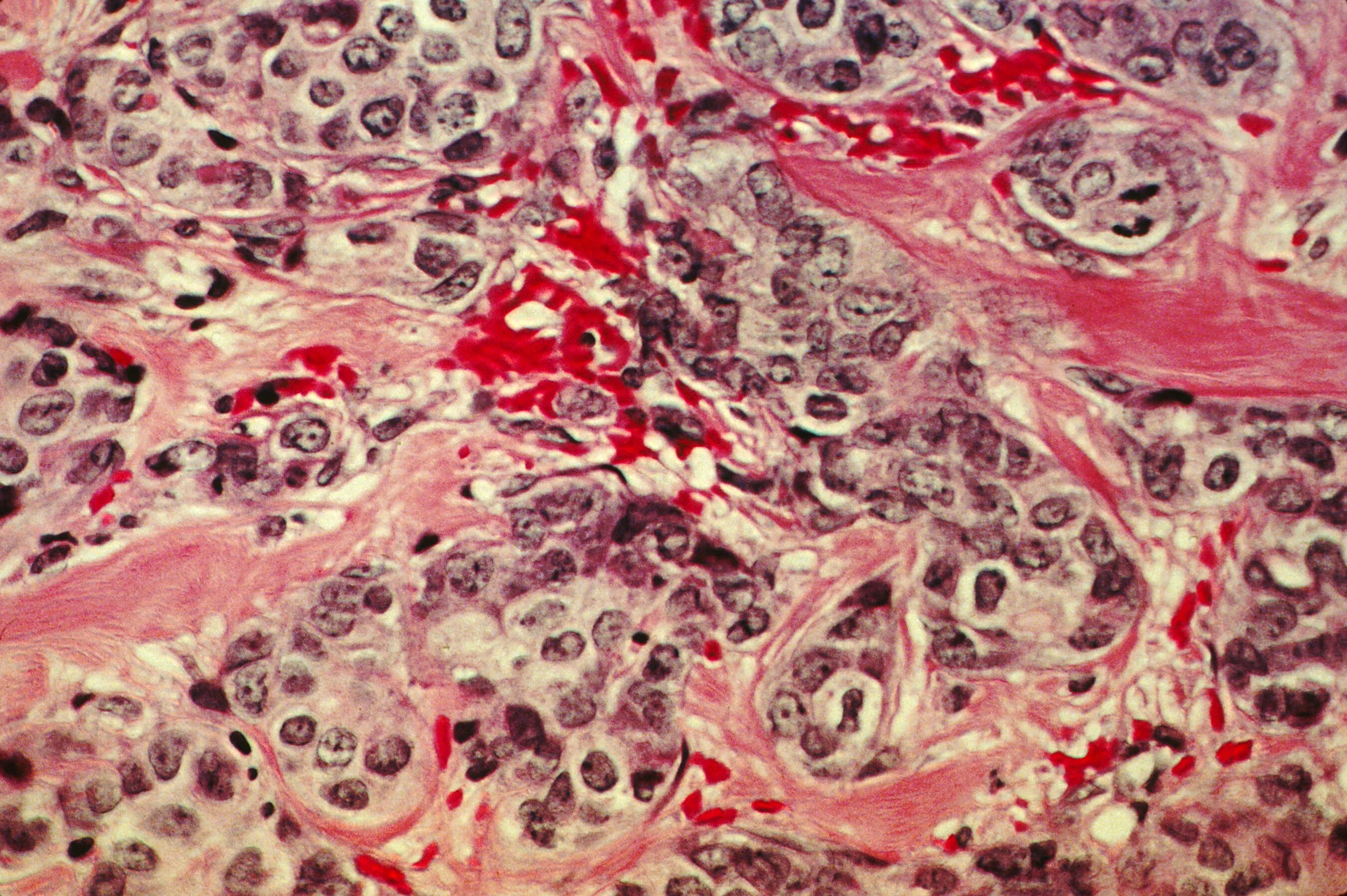 Псевдомиксома брюшины гистология. Раковые клетки под микроскопом. Злокачественные клетки под микроскопом. Злокачественная опухоль из соединительной