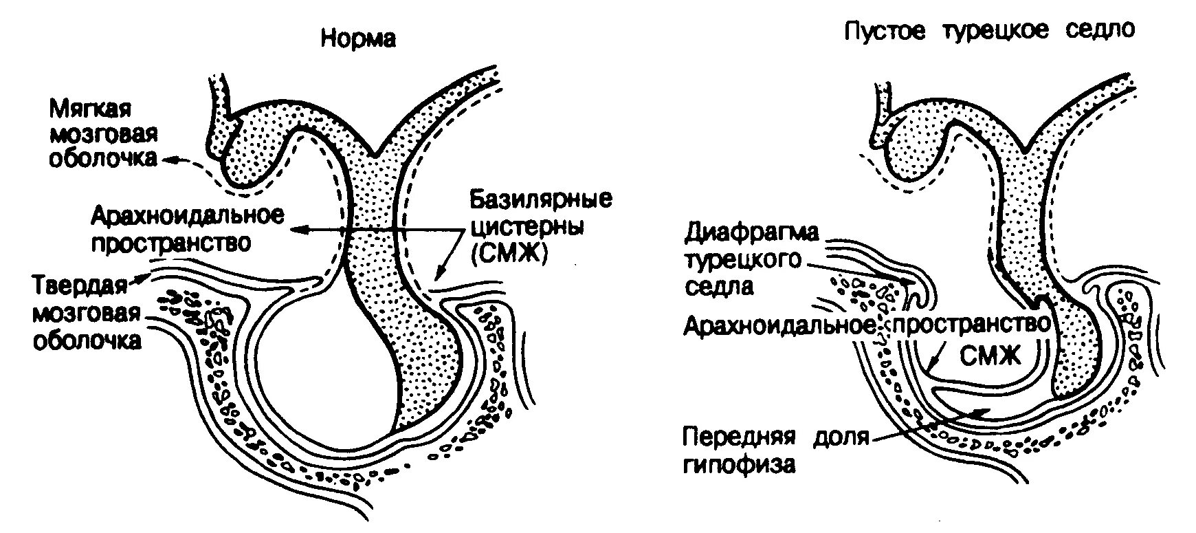 Пустое турецкое седло у мужчины. Синдром пустого турецкого седла кт. Синдром пустого турецкого седла. Симптом пустого турецкого седла. Пустое турецкое седло.