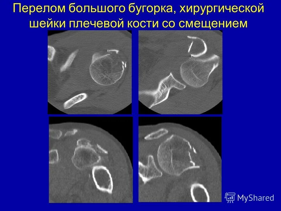 отрыв большого бугорка правой плечевой кости. чрезбугорковый перелом головки плечевой кости. изолированный перелом малого бугорка плечевой кости рентген. импрессионный перелом большого бугорка. перелом плечевой кости с отрывом большого бугорка.