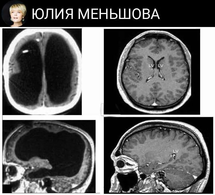 Отсутствие мозга