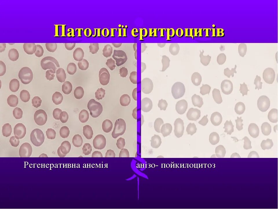 Пойкилоцитоз эритроцитов. Пойкилоцитоз эхиноциты. Виды пойкилоцитоза. Пойкилоцитоз в мазке крови. Эхиноциты