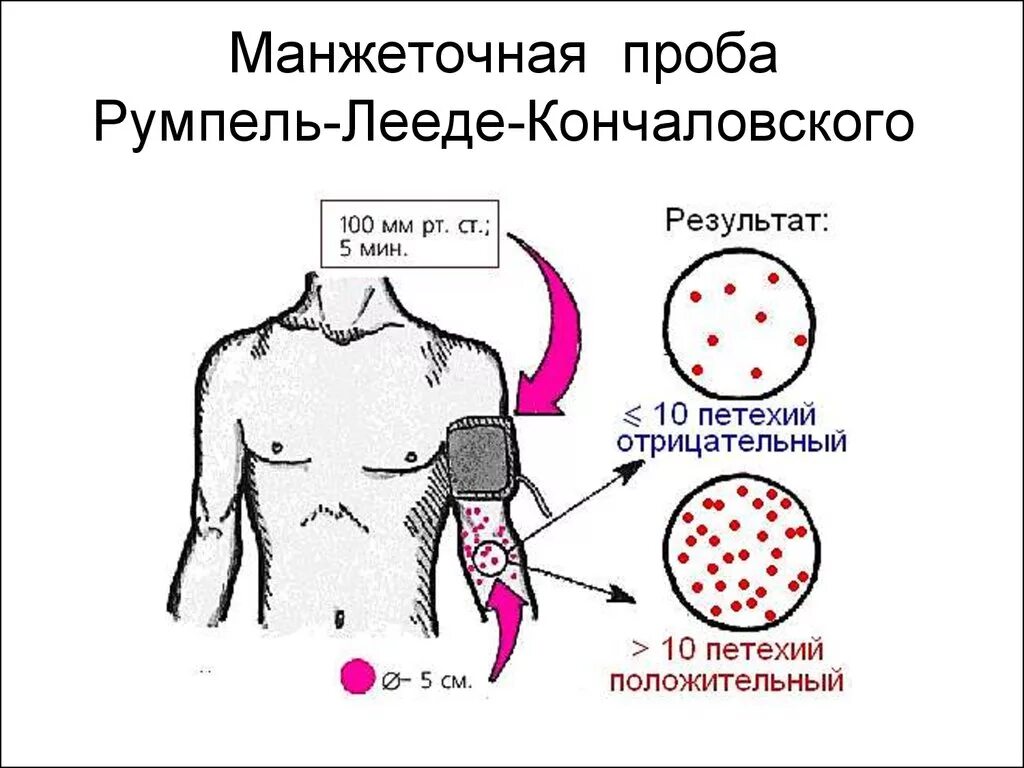 Резистентность крови. Манжеточная проба Кончаловского-румпеля-Лееде. Симптом жгута (симптом Кончаловского-румпеля-Лееде). Симптом жгута Кончаловского румпеля Лееде. Манжеточная проба румпеля.