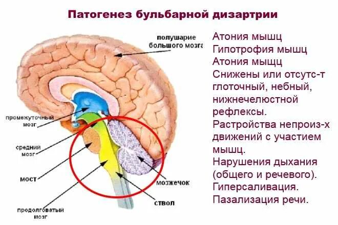 Резидуальная органическая головного мозга. Очаг поражения при бульбарной дизартрии. Псевдобульбарная дизартрия очаг поражения. Псевдобульбарная дизартрия патогенез. Очаг поражения при псевдобульбарной дизартрии.