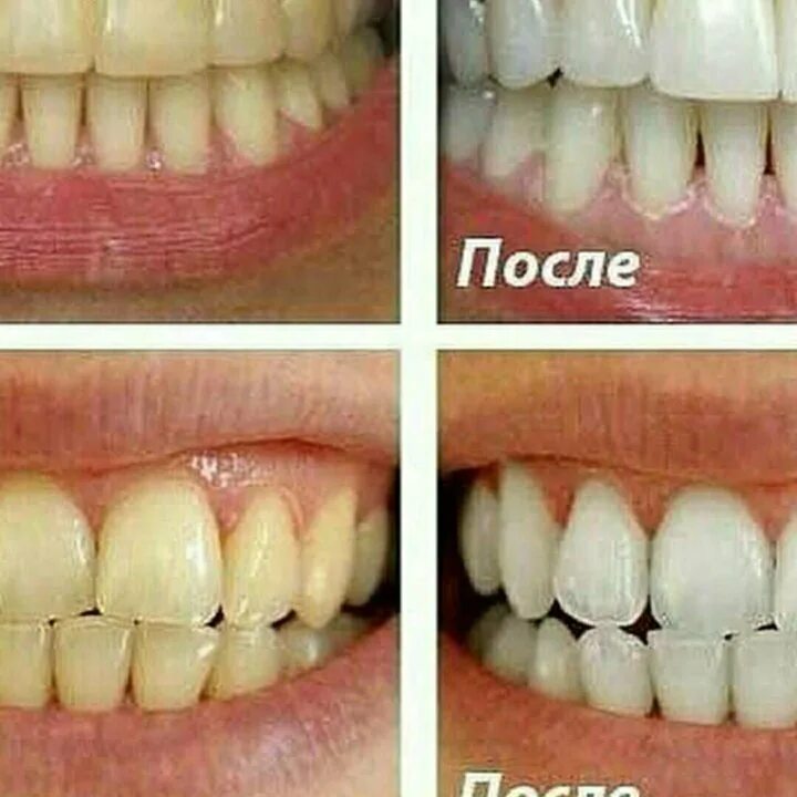 Фтор отбеливает. Отбеливание зубов до и после. Зубы до и после отбеливания. Зубы до и после отбеливающей пасты. Паста после отбеливания зубов.