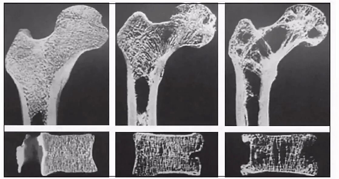 Остеопороз перелом рентген. Болезнь Горхема Стаута. Остеопороз костей рентген. Кость с остеопорозом рентген. Изменение структуры кости