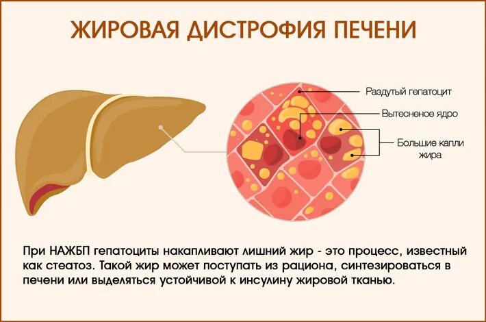 Жировые изменения печени и поджелудочной железы. Паренхима печени стеатоза. Жировой стеатоз печени симптомы. Острый жировой гепатоз стадии. Причина жировой дистрофии печени стеатоз.