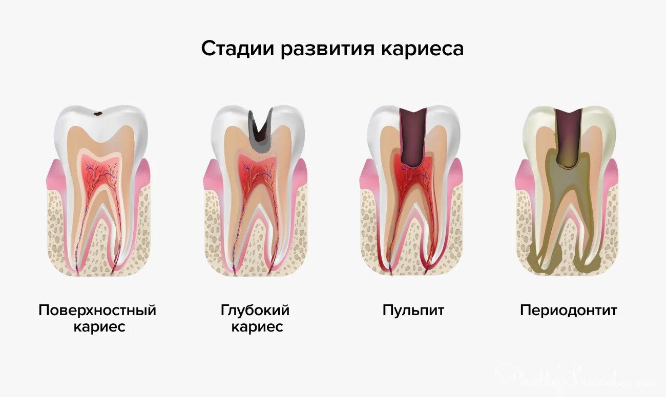 Кариес пульпит периодонтит. Зубы кариес пульпит периодонтит. Острый серозный периодонтит. Острый Гнойный периодонтит патогенез. Зубы болят и сверху и снизу