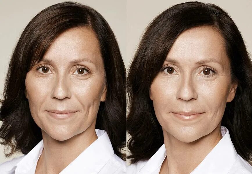 Контурная пластика лица. Омолаживающая пластика лица. Филеры в косметологии. Контурная пластика лица до и после. Процедура для лица после 60