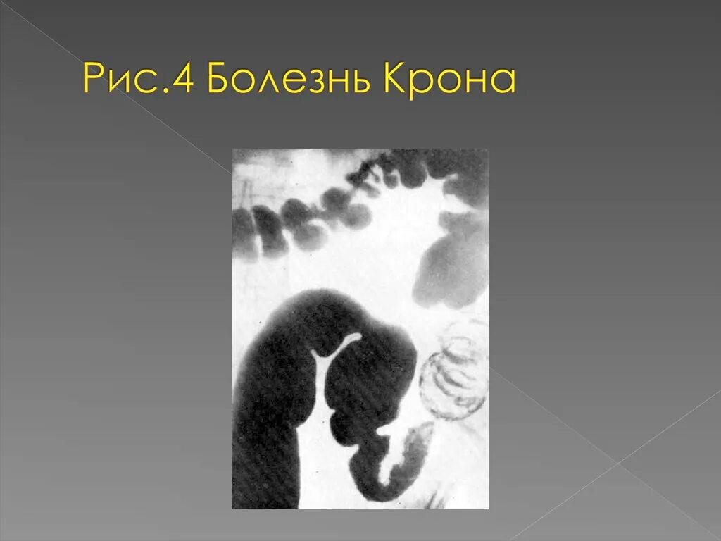 Balizin kirona. Болезнь крона эпидемиология. Болезнь крона характеризуется. Булыжная мостовая при болезни крона рентген. Пенетрирующая форма болезни крона.