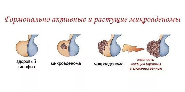 Гипофиза симптомы у женщин лечение прогноз. Аденома гипофиза классификация. клинические проявления опухоли гипофиза:. классификация аденом гипофиза. микроаденома гипофиза гормонально активная.