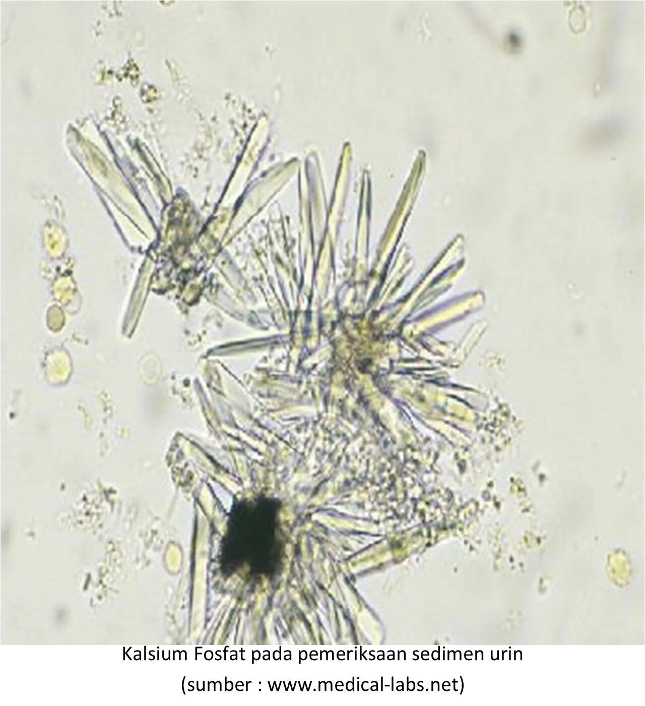 Иглы в моче. Кальция фосфат в моче микроскопия. Кристаллы фосфата кальция в моче. Фосфорнокислый кальций в моче микроскопия. Фосфорнокислый кальций Кристаллы в моче.