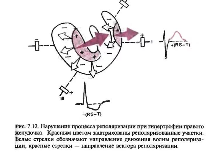 Реполяризации диффузного характера. Нарушение реполяризации миокарда левого желудочка на ЭКГ. Реполяризация миокарда желудочков ЭКГ. Нарушение процесса реполяризации желудочков. Неспецифические нарушения реполяризации на ЭКГ.