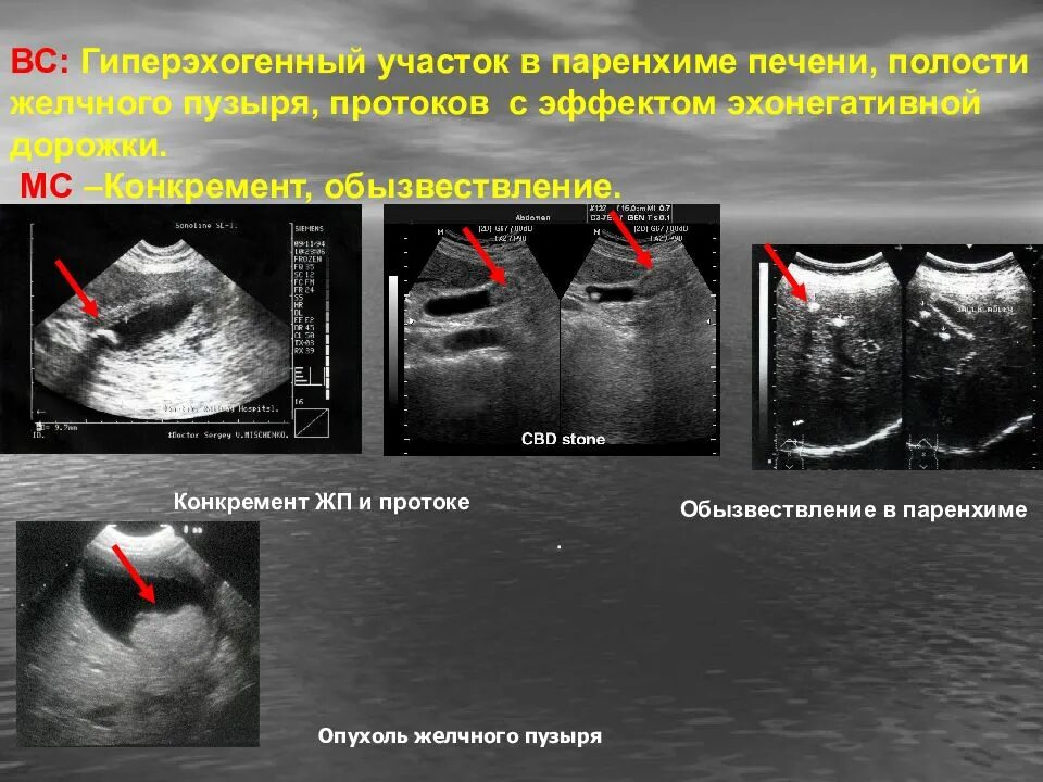 Образование в паренхиме печени. Гиперэхогенный желчный пузырь УЗИ. Объемное образование желчного пузыря. Гиперэхогенная печень. Гиперэхогенные участки.