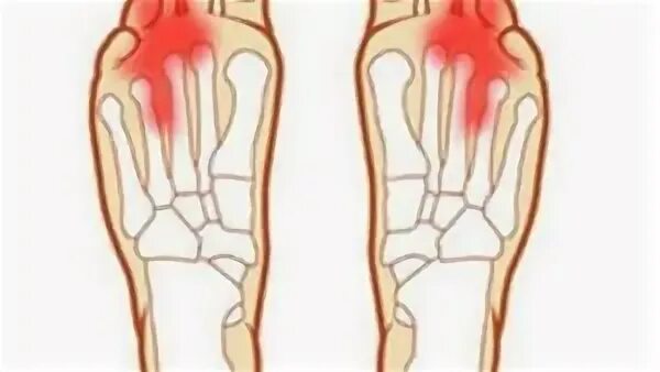 болят пальцы при ходьбе