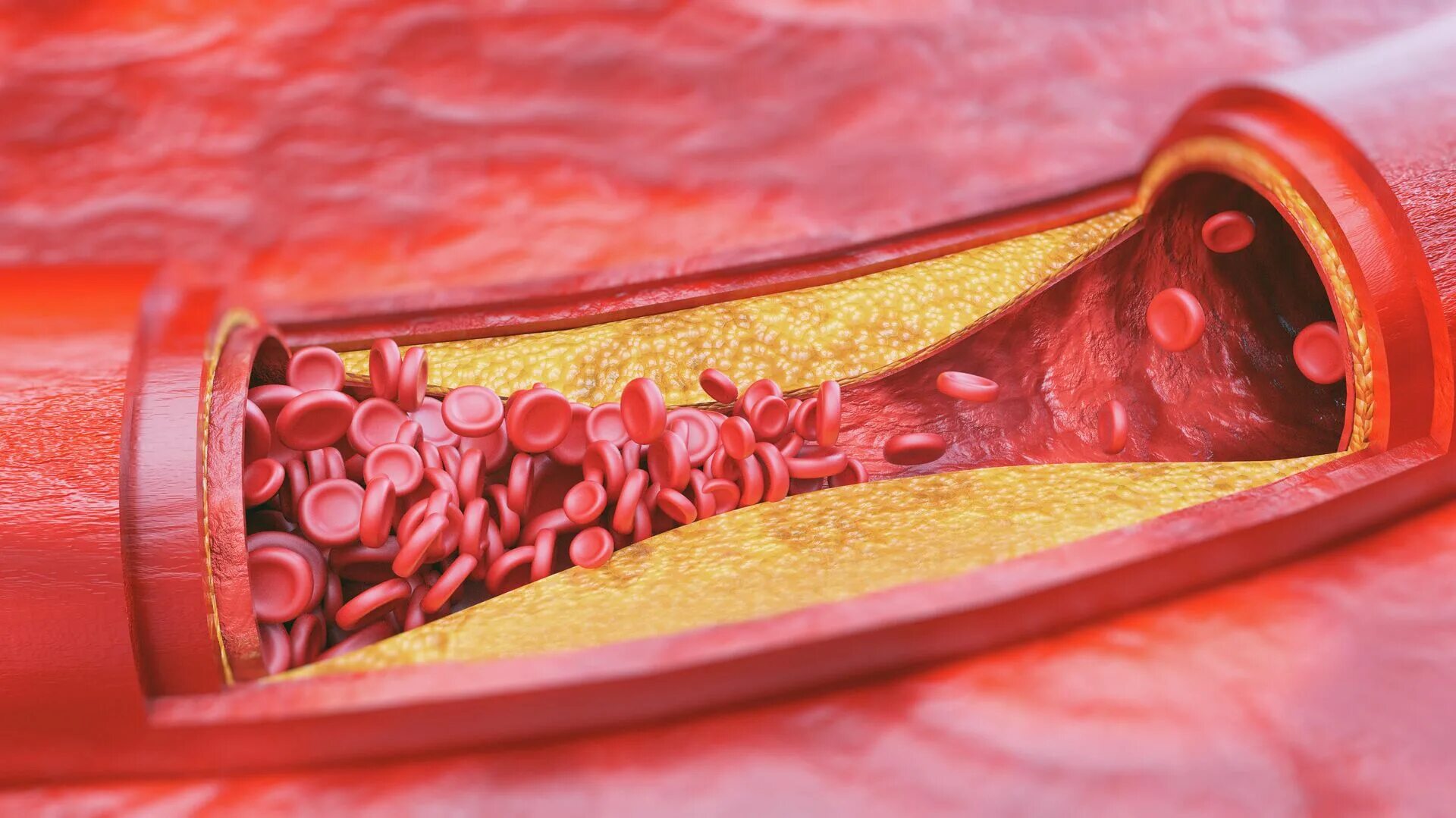 Болезни кровеносного сосуда. Атеросклероз (закупорка кровеносных сосудов). Тромбоз и эмболия и атеросклероз. Атеросклеротические бляшки в сосудах. Жировые бляшки в сосудах.