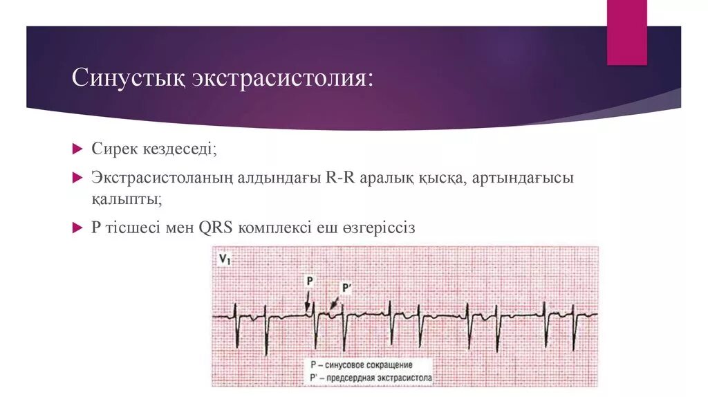 Синусовые экстрасистолы на ЭКГ. ЭКГ при экстрасистолии ритм синусовый. Синусовая и предсердная экстрасистолия. Синусово-предсердная экстрасистолия. Экстрасистолы ощущения