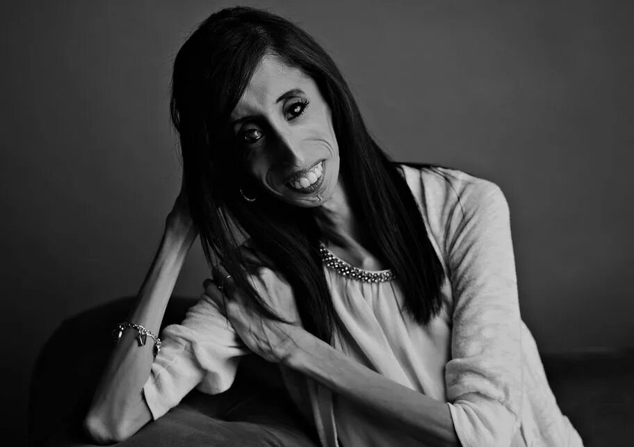 Лиззи Веласкес Lizzie Velasquez. Самая некрасивая женщина в мире Лиззи Веласкес. Страшная девочка картинка