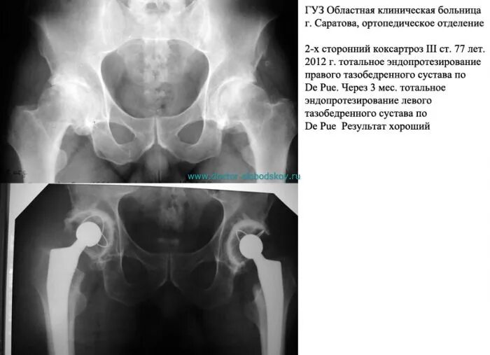 Коксартроз тазобедренного 3 степени операция. Протокол кт эндопротезирования тазобедренного сустава. рентген анатомия тазобедренного сустава коксартроз. кт эндопротеза тазобедренного сустава. коксартроз 3 ст тазобедренного сустава рентген.