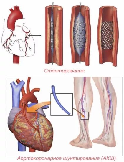 Транслюминальная ангиопластика. Шунтирование сосудов сердца стент. Чем отличается стентирование от шунтирования сосудов сердца. Что такое шунтирование сосудов сердца и стентирование. Стентирование сосудов топографическая анатомия.