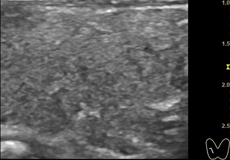 Маточная и внематочная беременность узи. Эктопическая беременность узи картина. Узи малого таза миома матки заключение. Пол ребенка на узи. Расширенная полость матки.