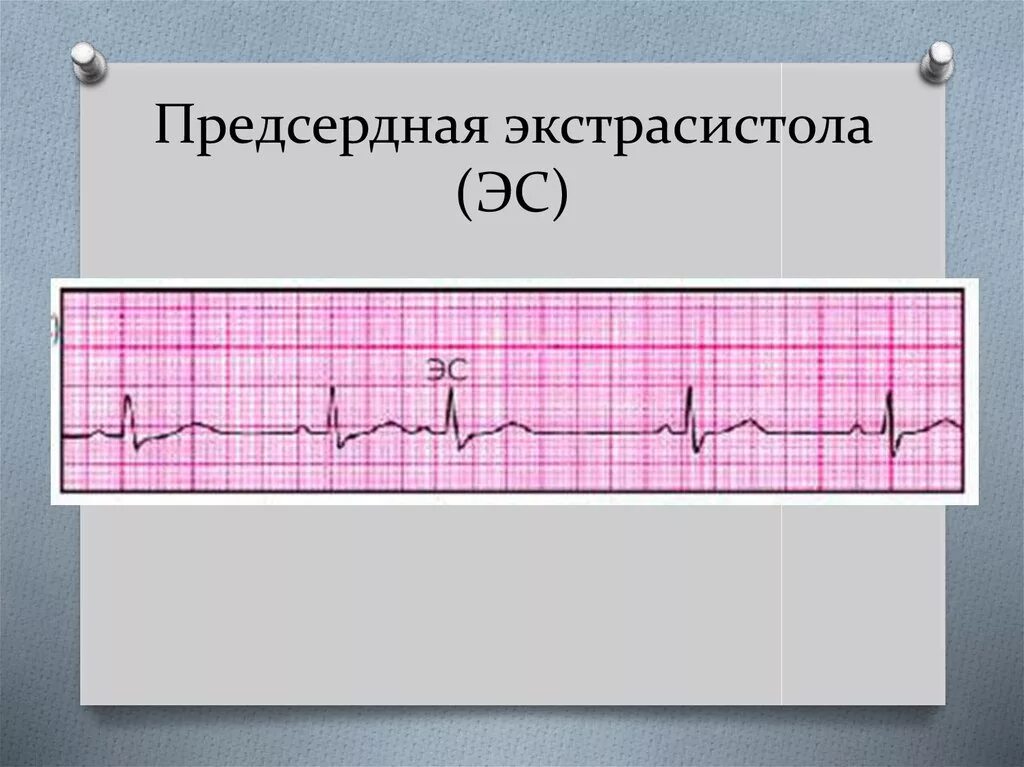 Единичная предсердная экстрасистола. Экстрасистола предсердия на ЭКГ. Предсердная экстрасистолия на ЭКГ. Предсердные экстрасистолы на ЭКГ. Блокированные экстрасистолы