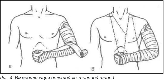 Иммобилизация при переломе кисти руки. Иммобилизация при переломе в типичном месте. Гипсовая иммобилизация. Иммобилизация при переломе в типичном месте. Иммобилизация пострадавшего при переломе костей таза.