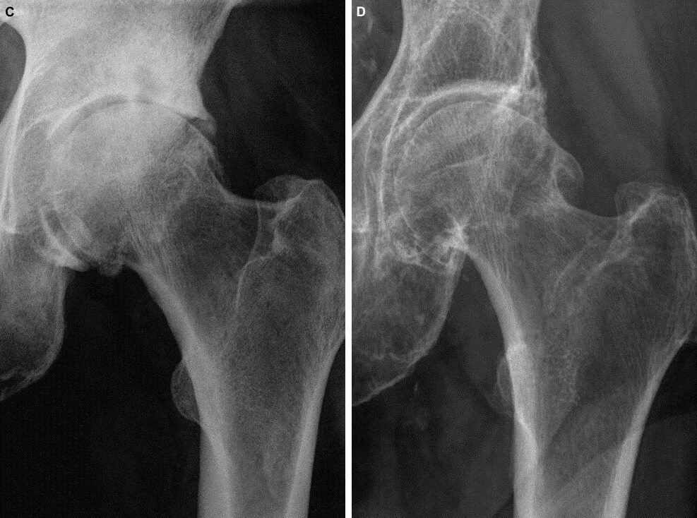 Артрит артроз тазобедренных суставов. Тазобедренный артроз 1 стадия. Коксартроз 2 степени рентген. Снимок коксартроза тазобедренного сустава 2 степени. Деформирующий артроз тазобедренного сустава рентген.