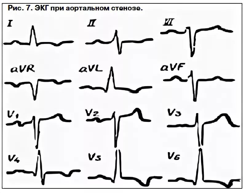Косонисходящая депрессия сегмента St. Депрессия сегмента St на ЭКГ. Депрессия сегмента St в отведениях v5 v6. Вогнутая депрессия сегмента St. Низкоамплитудная экг что это значит