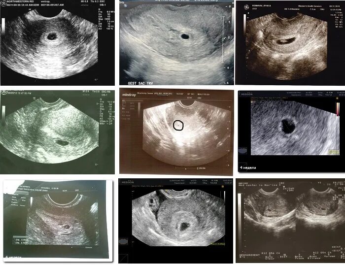 Эмбрион на 2 неделе беременности. Плод в 3 недели беременности на УЗИ. Плод 3-4 недели беременности на УЗИ. Эмбрион на 3-4 недели беременности. УЗИ 2-3 недели беременности от зачатия.