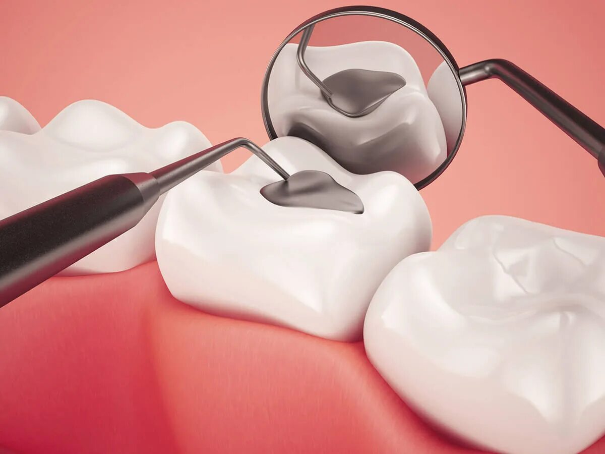 Tooth filling