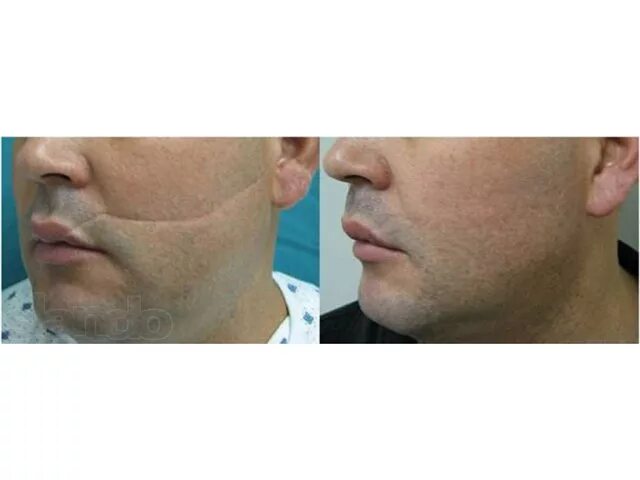 Дерматикс мазь от шрамов. Печать радогона от шрамов. Bioaqua removal of acne крем для лица. Дерматикс мазь от шрамов. Лазерная наноперфорация постакне.
