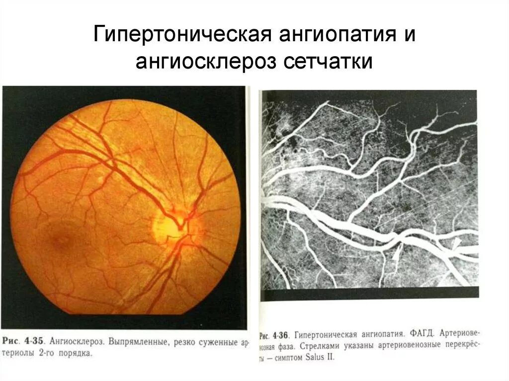 Ангиопатия сосудов мкб. Ангиосклероз сосудов глазного дна. Исследование сосудов глазного дна при гипертонической болезни. Гипертоническая ангиопатия и ретинопатия. Ангиопатия сосудов сетчатки.